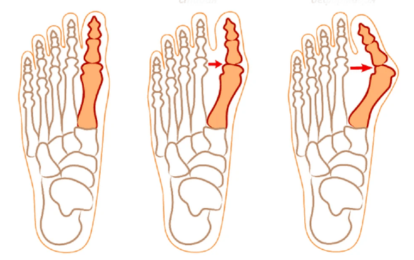Deformation of Hallux Valgus