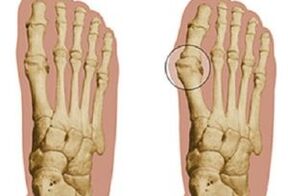 Causes of hallux valgus