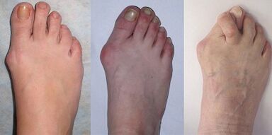 phases of hallux valgus