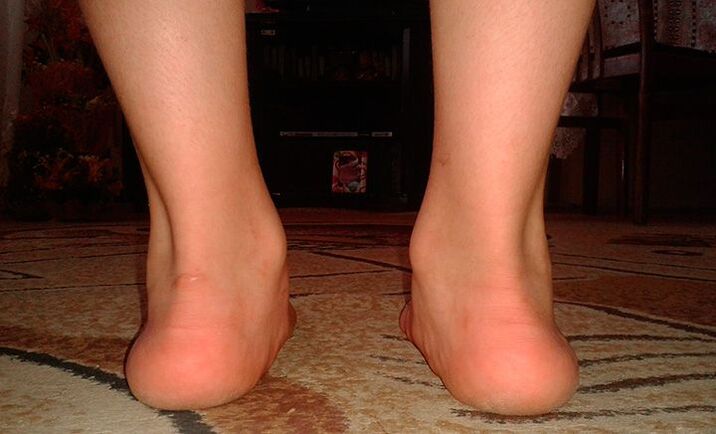 Flat feet valgus