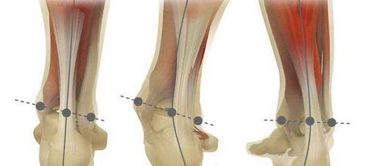 The norm of the leg axis and its curvature in case of plano-valgus deformity