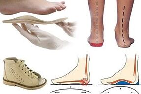 Orthopedic shoes for hallux valgus in a child