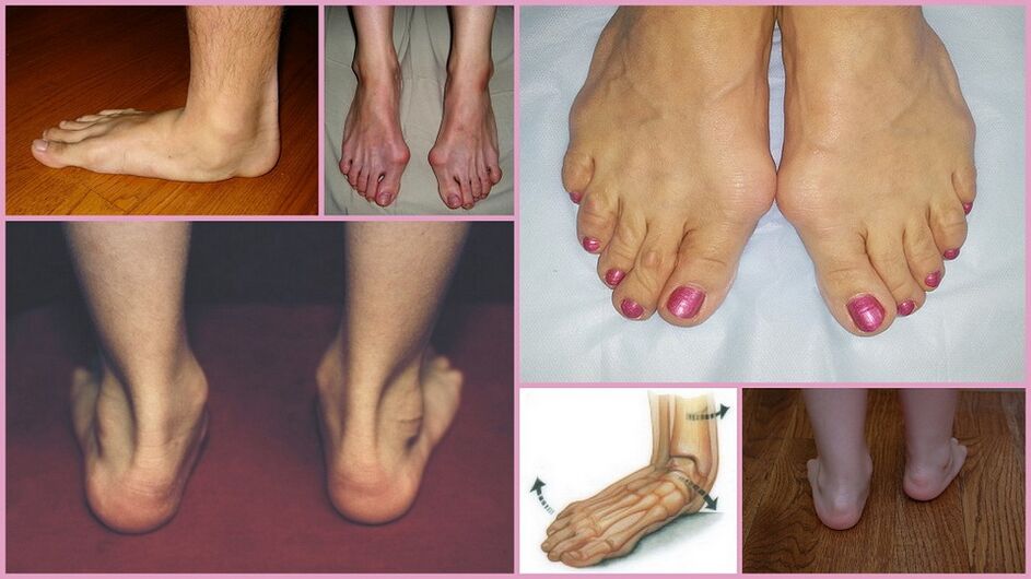 Manifestations of foot valgus in adults