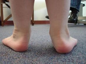 Flat foot valgus deformity in a child