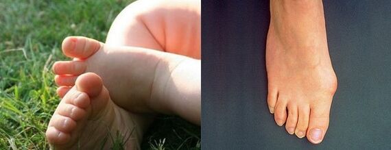 Deformation of the valgus of the first toe