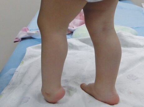 The first symptoms of foot valgus deformation