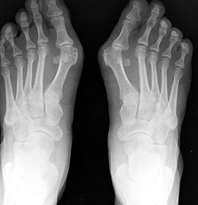 X -Foot
